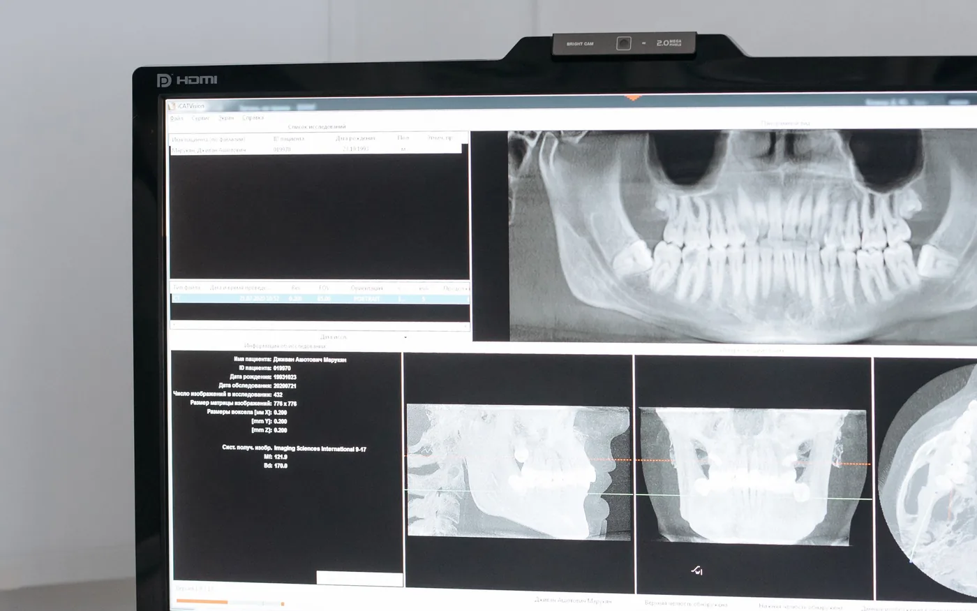 Dental radiograph displayed on a computer monitor