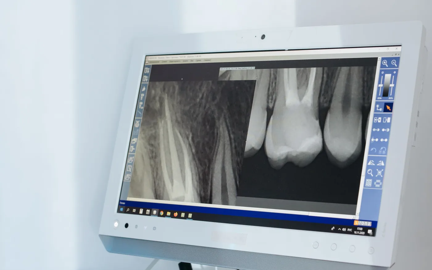 Computer screen displaying dental X-ray images